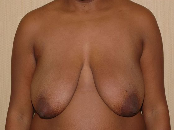 Breast Reduction Case 6 - Indianapolis - Before