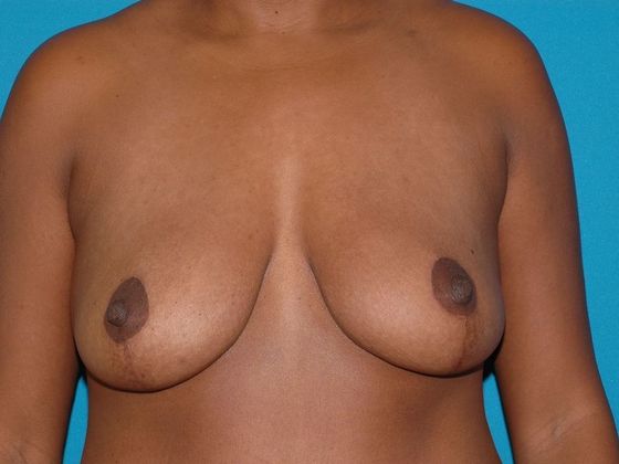 Breast Reduction Case 6 - Indianapolis - After