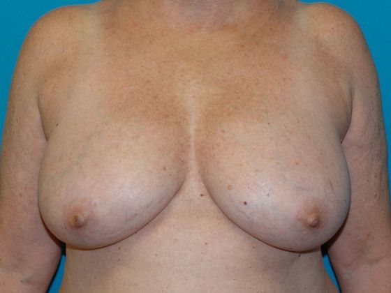 Breast Reduction Case 7 - Avon - Before