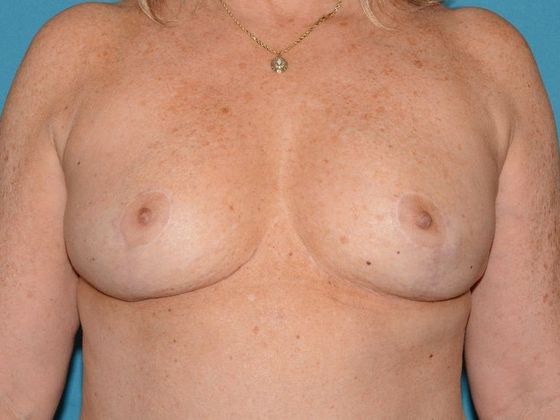 Breast Reduction Case 7 - Avon - After