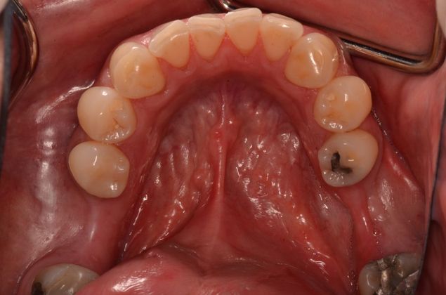 Dental Implants Case 29 - Before