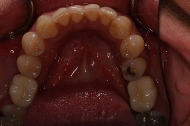 Dental Implants Case 29 - After