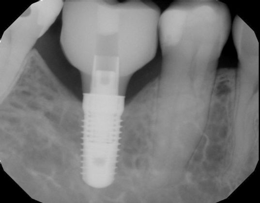 Dental Implants: Case 29 - Implant on patient