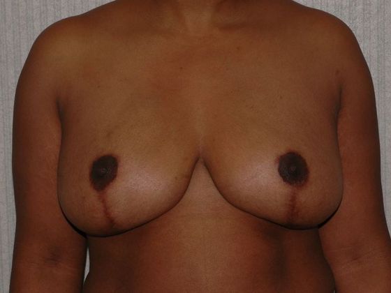 Breast Reduction Case 8 - Fishers - After