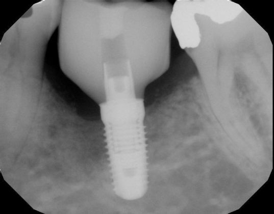 Dental Implants: Case 29 - Implant on patient