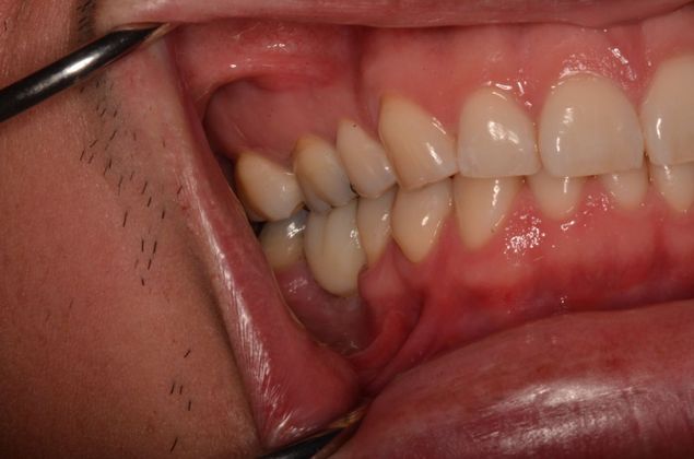 Dental Implants: Case 29 - Final screw retained implant crown