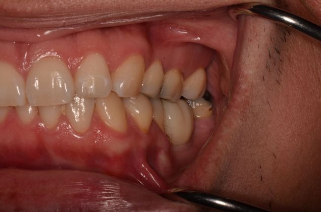 Dental Implants: Case 29 - Final screw retained implant crown