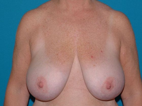 Breast Reduction Case 9 - Terre Haute - Before