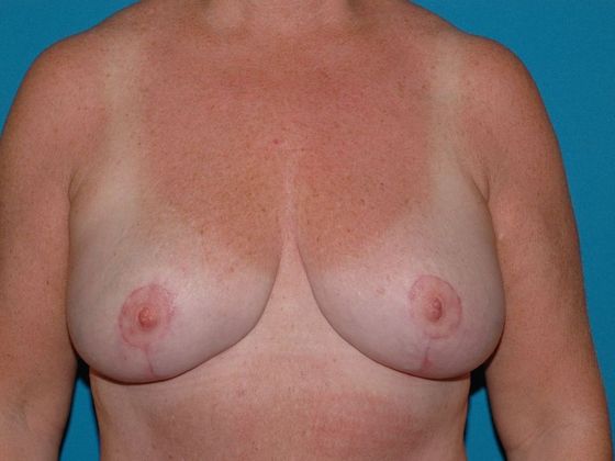 Breast Reduction Case 9 - Terre Haute - After