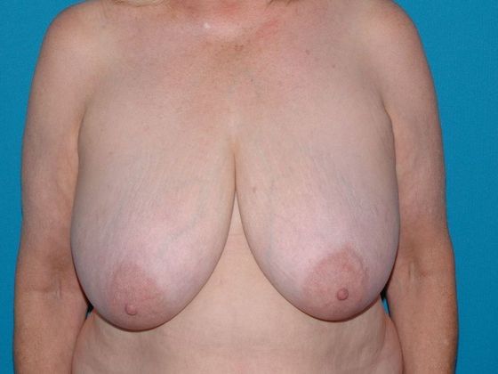 Breast Reduction Case 11 - Carmel - Before