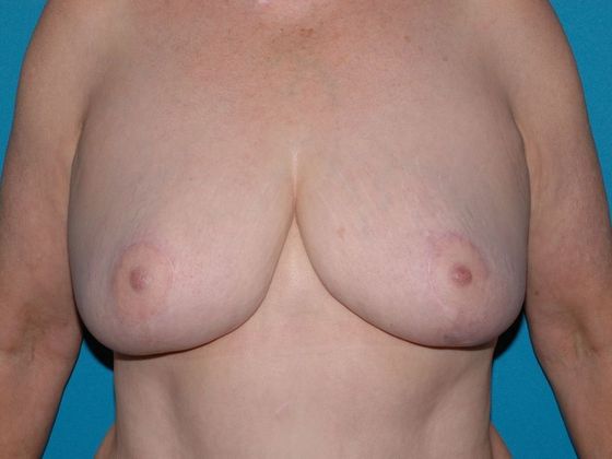 Breast Reduction Case 11 - Carmel - After