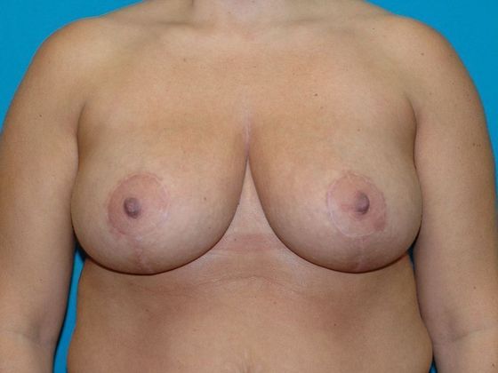 Breast Reduction Case 12 - Indianapolis - After