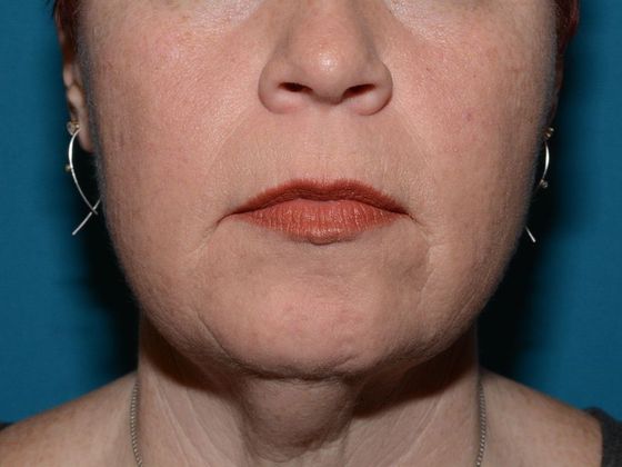Facelift Case 2 - Indianapolis - Before