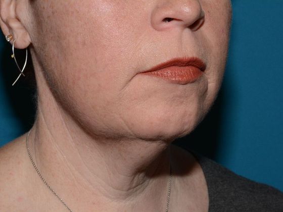 Facelift: Case 2 - Indianapolis - Before