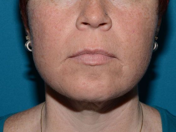 Facelift Case 2 - Indianapolis - After