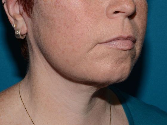 Facelift: Case 2 - Indianapolis - After
