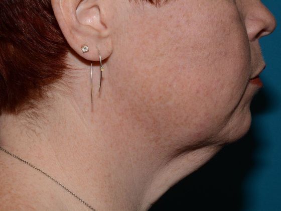 Facelift: Case 2 - Indianapolis - Before