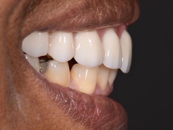 Prettau Zirconia Implant Bridge: Darlene - After