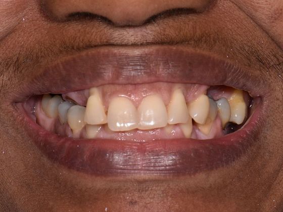 Prettau Zirconia Implant Bridge: Darlene - Before