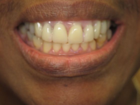 Prettau Zirconia Implant Bridge: Darlene - After