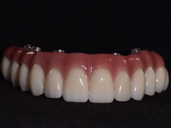 Prettau Zirconia Implant Bridge: Darlene - Final Zirconia Bridge