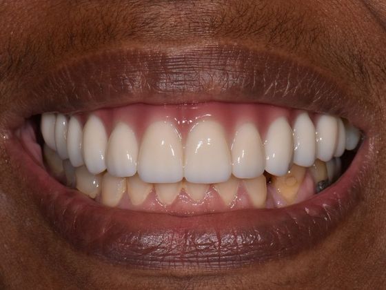 Prettau Zirconia Implant Bridge: Darlene - After