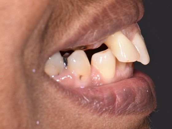 Prettau Zirconia Implant Bridge: Darlene - Before