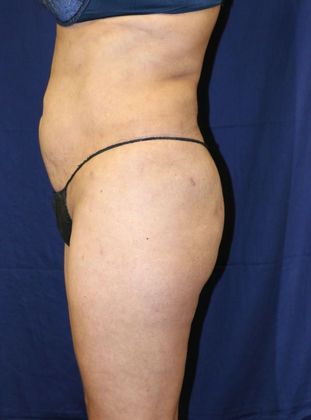 Liposuction & Safe Lipo: Case 39 - After