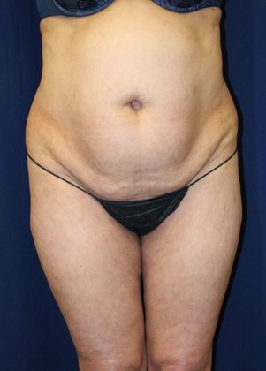 Liposuction & Safe Lipo: Case 39 - After