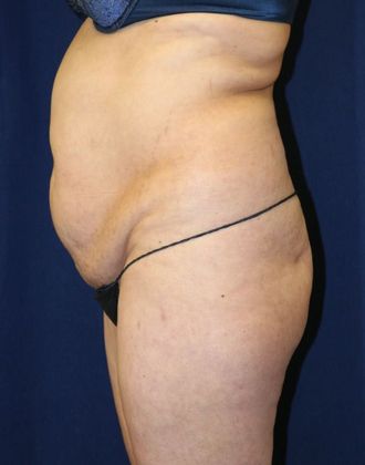 Liposuction & Safe Lipo: Case 39 - Before