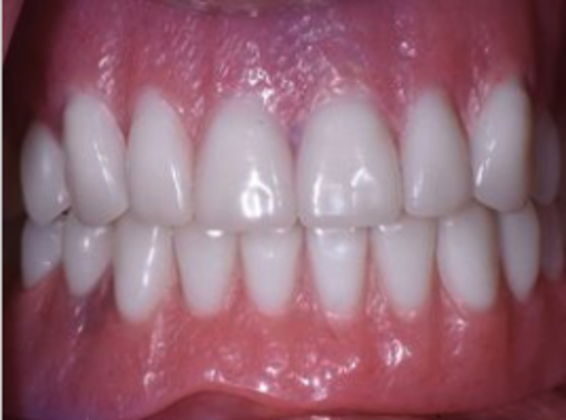 Traditional Dentures Cases