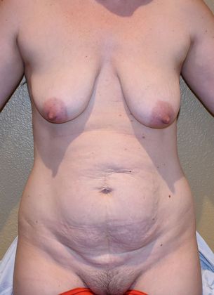 Mommy Makeover Case 137 - Before