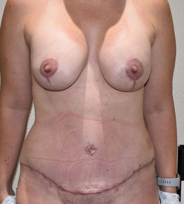 Mommy Makeover Case 137 - After