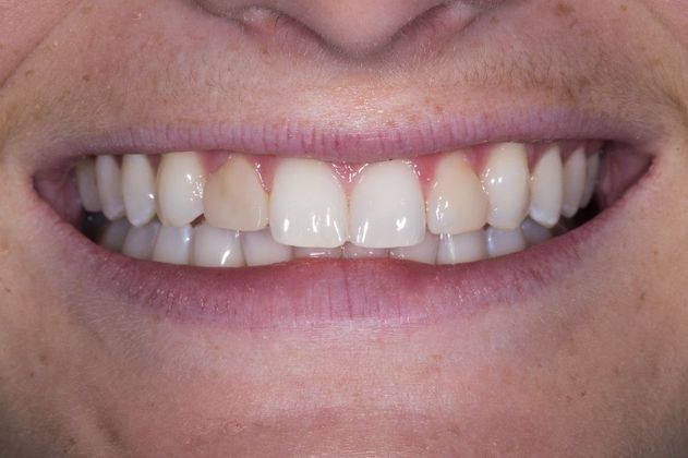 Case One - Lateral Incisors - Dental Veneers - Before and After Gallery