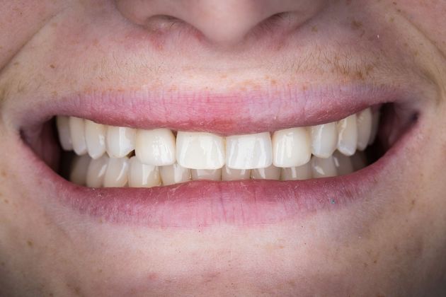 Dental Veneers: Case One - Lateral Incisors - After