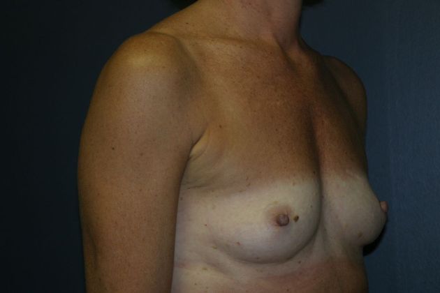 Breast Augmentation: Case 4 - Before