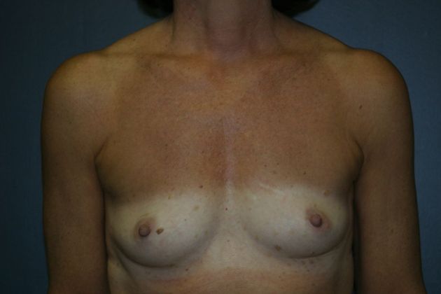Breast Augmentation: Case 4 - Before
