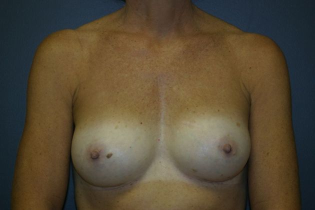 Breast Augmentation: Case 4 - After