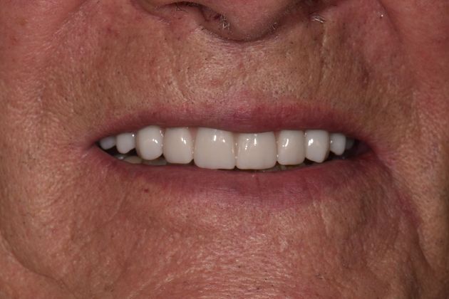 Prettau Zirconia Implant Bridge: Louis - After