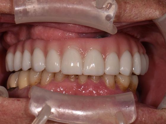 Prettau Zirconia Implant Bridge: Louis - After