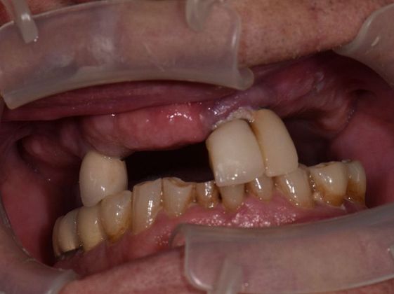 Prettau Zirconia Implant Bridge: Louis - Before