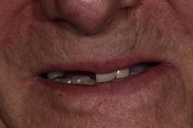 Prettau Zirconia Implant Bridge: Louis - Before