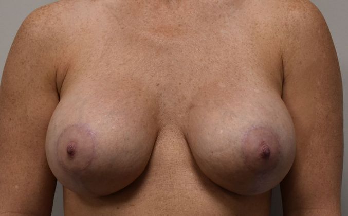 Breast Augmentation w/ Lift Case 276 - After