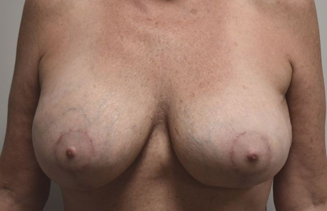 Breast Revision: Case 116 - After