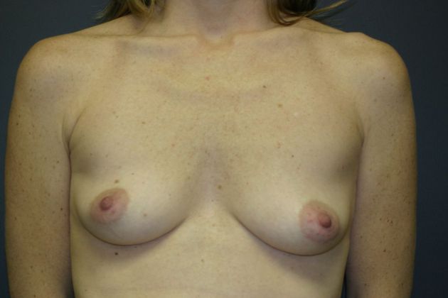 Breast Augmentation: Case 10 - Before