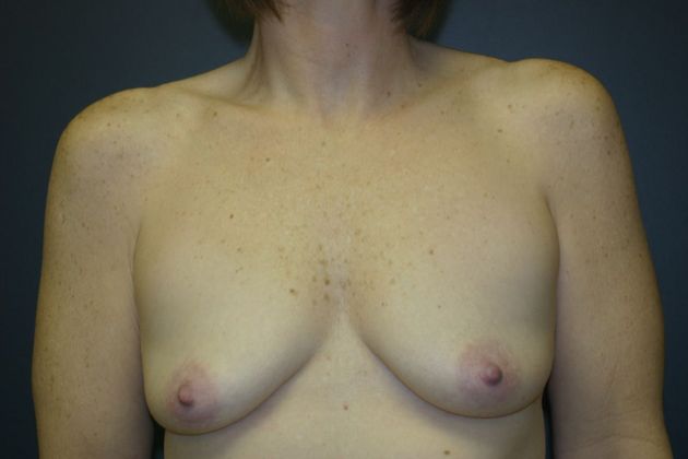 Breast Augmentation: Case 12 - Before