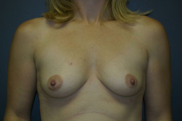 Breast Augmentation: Case 14 - Before