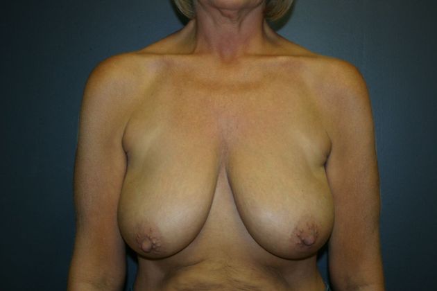 Breast Lift: Case 1 - Before
