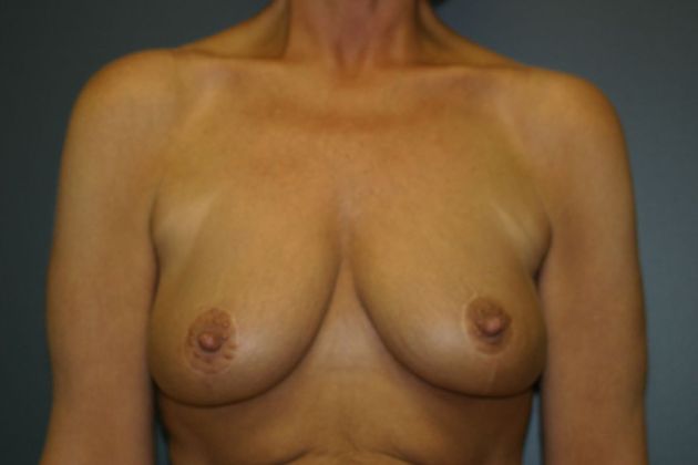 Breast Lift: Case 1 - After