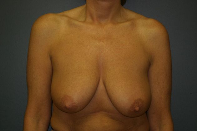 Breast Lift: Case 2 - Before